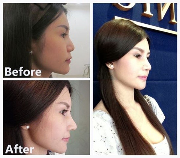 Loạt ảnh trước và sau phẫu thuật thẩm mỹ của những cô gái Thái 2