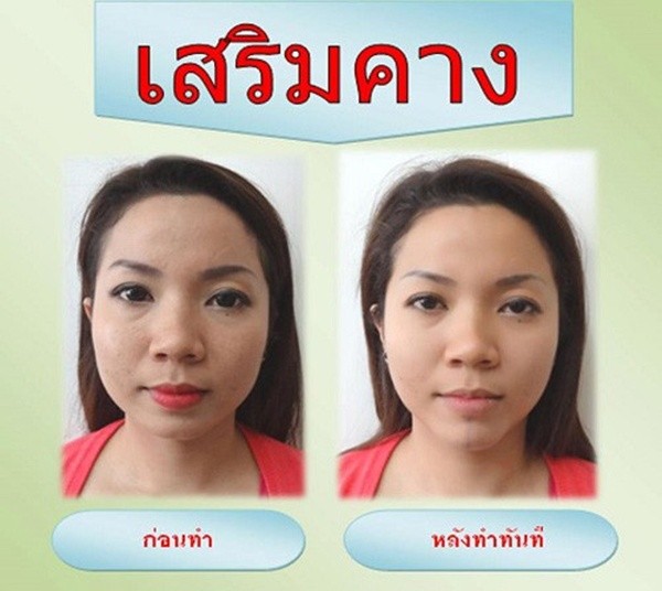 Loạt ảnh trước và sau phẫu thuật thẩm mỹ của những cô gái Thái 14