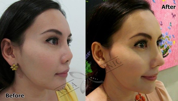 Loạt ảnh trước và sau phẫu thuật thẩm mỹ của những cô gái Thái 1