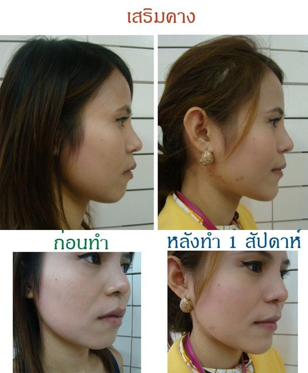 Loạt ảnh trước và sau phẫu thuật thẩm mỹ của những cô gái Thái 16