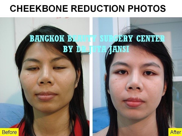 Loạt ảnh trước và sau phẫu thuật thẩm mỹ của những cô gái Thái 11