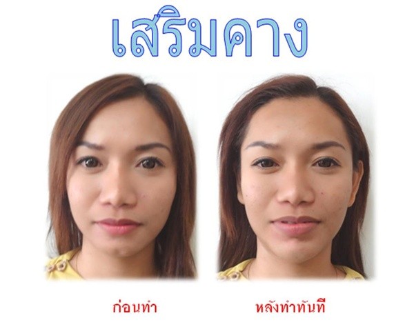 Loạt ảnh trước và sau phẫu thuật thẩm mỹ của những cô gái Thái 6