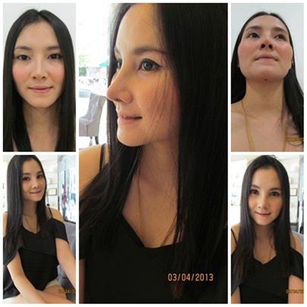 Loạt ảnh trước và sau phẫu thuật thẩm mỹ của những cô gái Thái 10