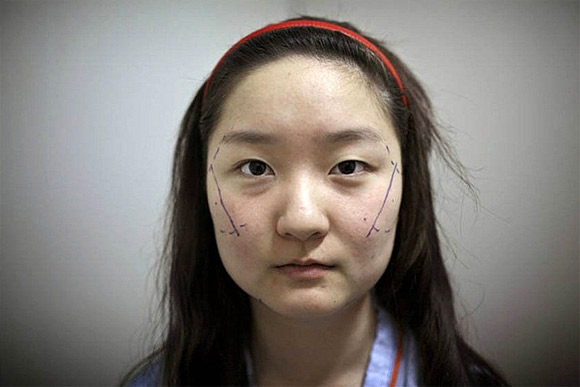  Nỗi đau đớn của thiếu nữ Hàn Quốc khi phẫu thuật thẩm mỹ 6