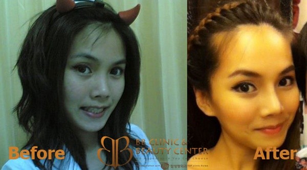 Loạt ảnh trước và sau phẫu thuật thẩm mỹ của những cô gái Thái 12