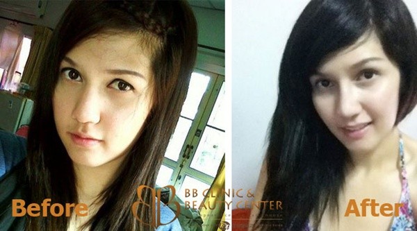 Loạt ảnh trước và sau phẫu thuật thẩm mỹ của những cô gái Thái 13