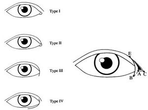 Phẫu thuật mở rộng góc mắt - &quot;thủ thuật&quot; để có đôi mắt to tròn 2