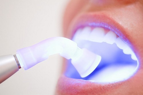 Bệnh nhân có răng muốn tẩy trắng phải là người có ít răng sâu, không có răng giả nhiều, răng không có miếng trám to. Vì răng thật và răng còn sống mới tẩy trắng được, răng giả và răng có miếng trám không tẩy được.