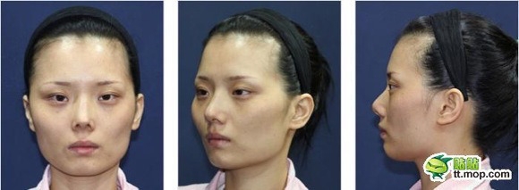 Hành trình phẫu thuật thẩm mỹ của một cô gái Hàn