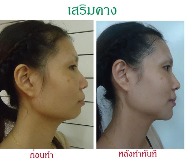 Loạt ảnh trước và sau phẫu thuật thẩm mỹ của những cô gái Thái 7