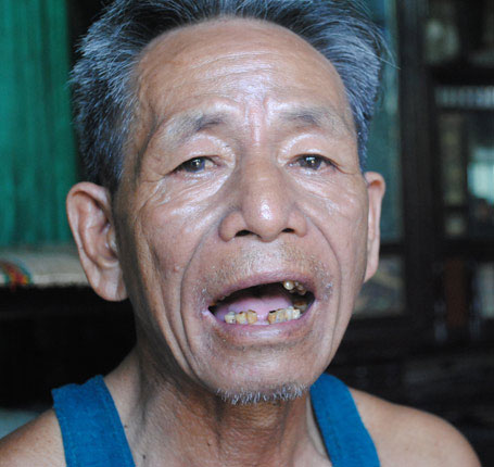 Hàm răng của ông Phan Cường tan nát vì làm nghề cắn chì