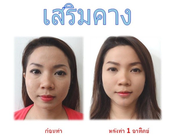 Loạt ảnh trước và sau phẫu thuật thẩm mỹ của những cô gái Thái 5