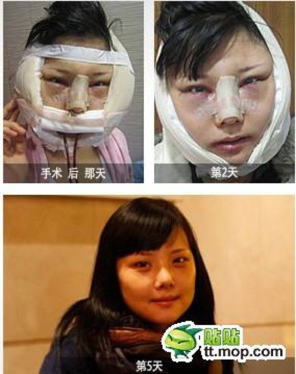 Hành trình phẫu thuật thẩm mỹ của một cô gái Hàn