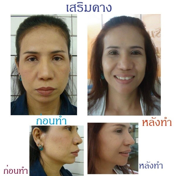 Loạt ảnh trước và sau phẫu thuật thẩm mỹ của những cô gái Thái 4