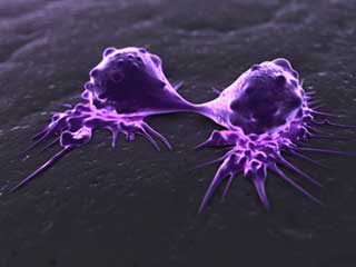 Khối u ung thư có thể bị tiêu diệt bằng cách cắt nguồn dưỡng chất. Ảnh: Science Photo Library