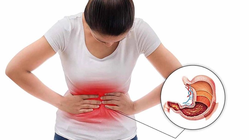 Phát hiện mới nhất về khả năng điều trị bệnh viêm loét dạ dày của bốn loài thực vật